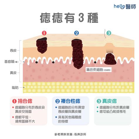 脖子痣長毛代表什麼|痣形成的原因？痣長毛、痣變多變大是痣病變？5招判。